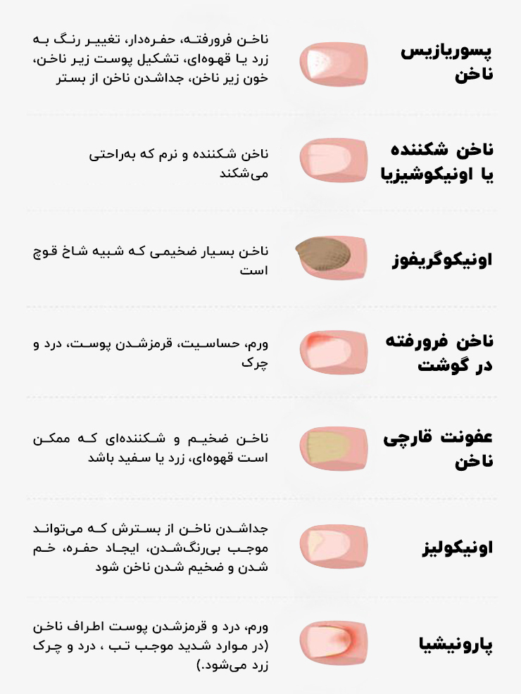 رایج ترین بیماری های ناخن پا