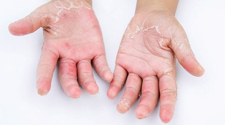 مهم ترین علائم و علت حساسیت به لاتکس دستکش