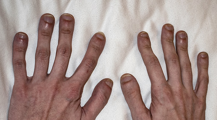 انگشتان پا از علائم فیبروز ریوی هستند
