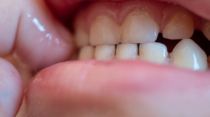 مشکلات دهان و دندان از دلایل دندان قروچه کودک