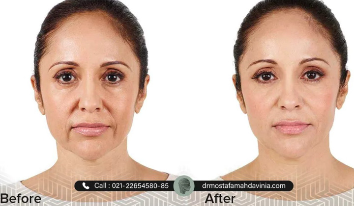 عکس قبل و بعد از تزریق ژل خط خنده