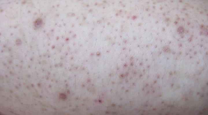 دلایل ایجاد پاهای توت فرنگی