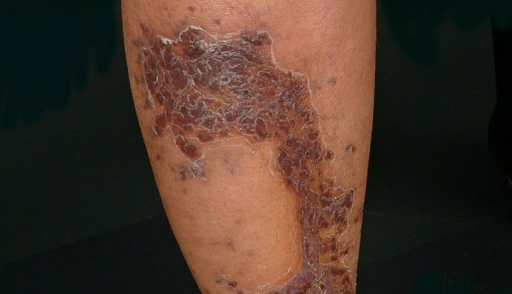 تومور سارکوم کاپوزی روی پوست پا