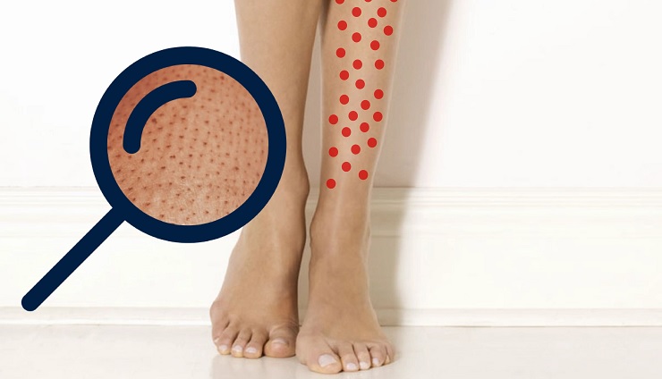 پاهای توت فرنگی: نقاط تیره پوست پا بعد از شیوکردن یا اپیلاسیون
