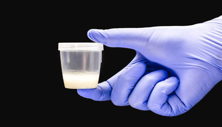 کاپ حاوی مایع منی برای آزمایش اسپرم