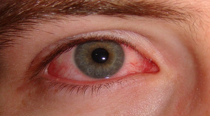 قرمزی چشم از علائم سندرم شوک سمی
