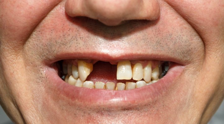 فردی بدون یک دندان جلو - پریودنتیت درمان‌نشده منجر به ازدست‌دادن دندان می‌شود