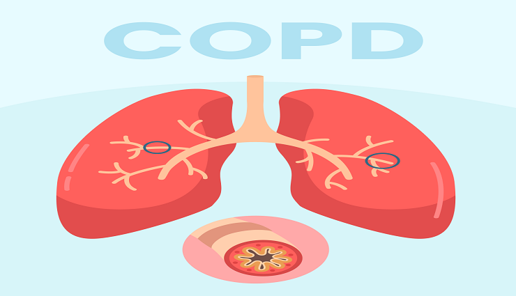 COPD چیست