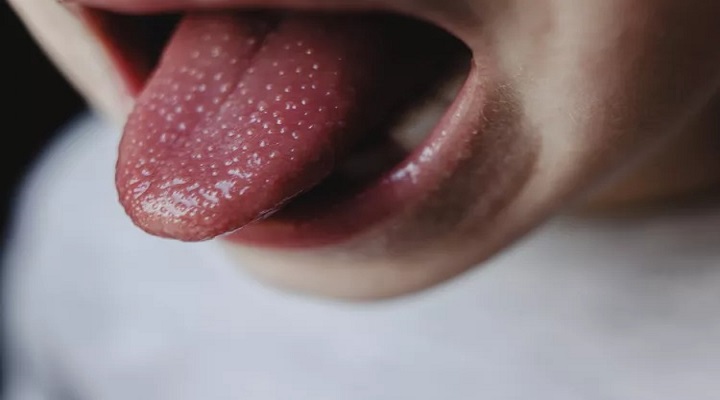 زبان توت فرنگی شکل زمان ابتلا به تب اسکارلت