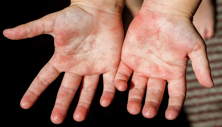 دست‌های کودکی که دچار مخملک شده است