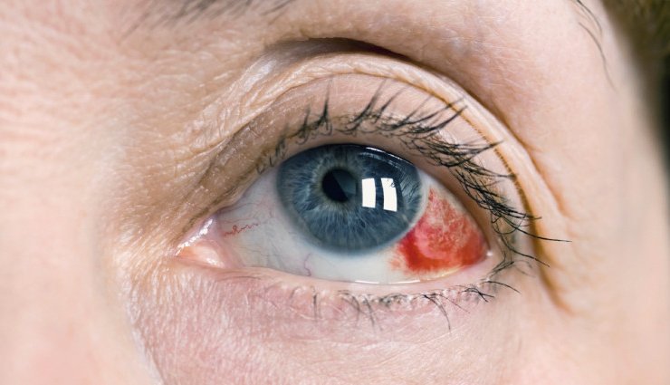 سکته چشمی - تصویری از لخته خون داخل چشم