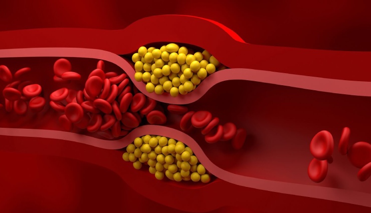 کلسترول بد خون به شکل دایره‌های زردرنگ
