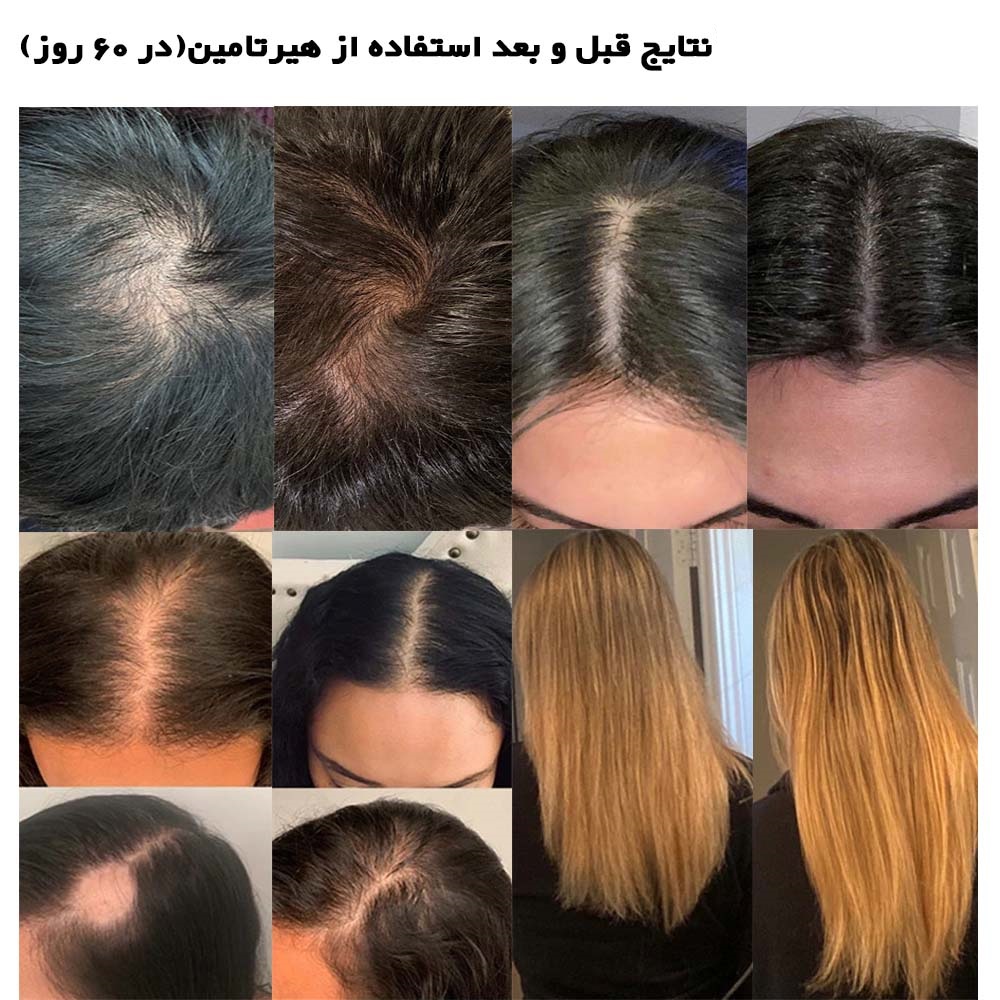 نتایج مصرف کنندگان قرص هیرتامین