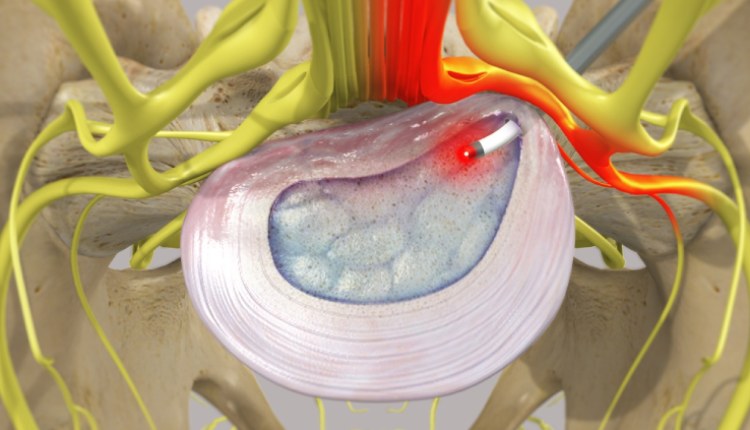 عمل جراحی دیسک کمر با لیزر چگونه است؟