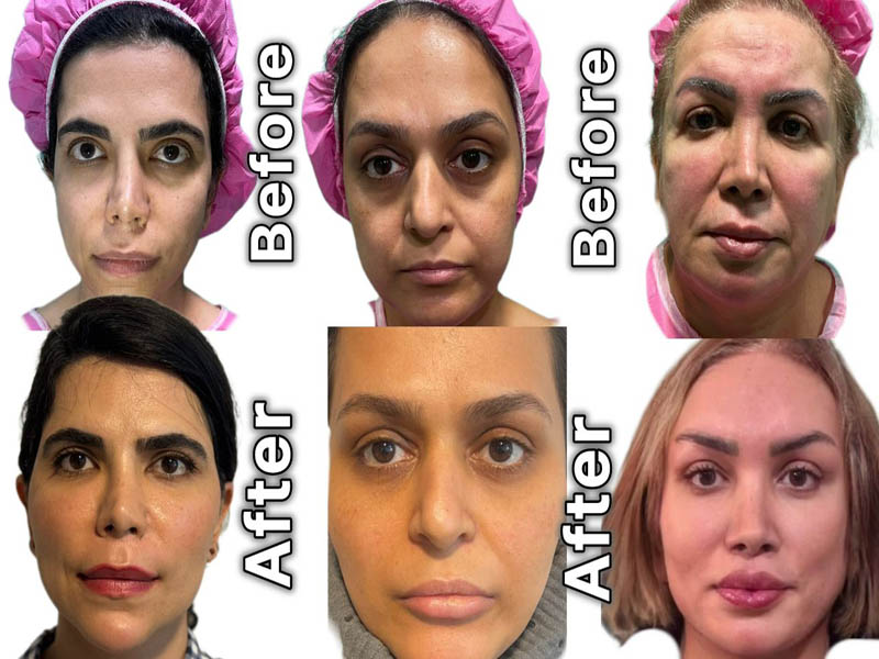 جوانسازی طبیعی صورت با نوراریژن