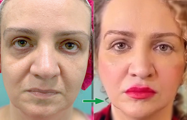 نتایج قبل و بعد از تزریق چربی به روش نوراریژن