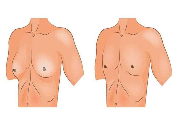تفاوت ژنیکوماستی واقعی و کاذب