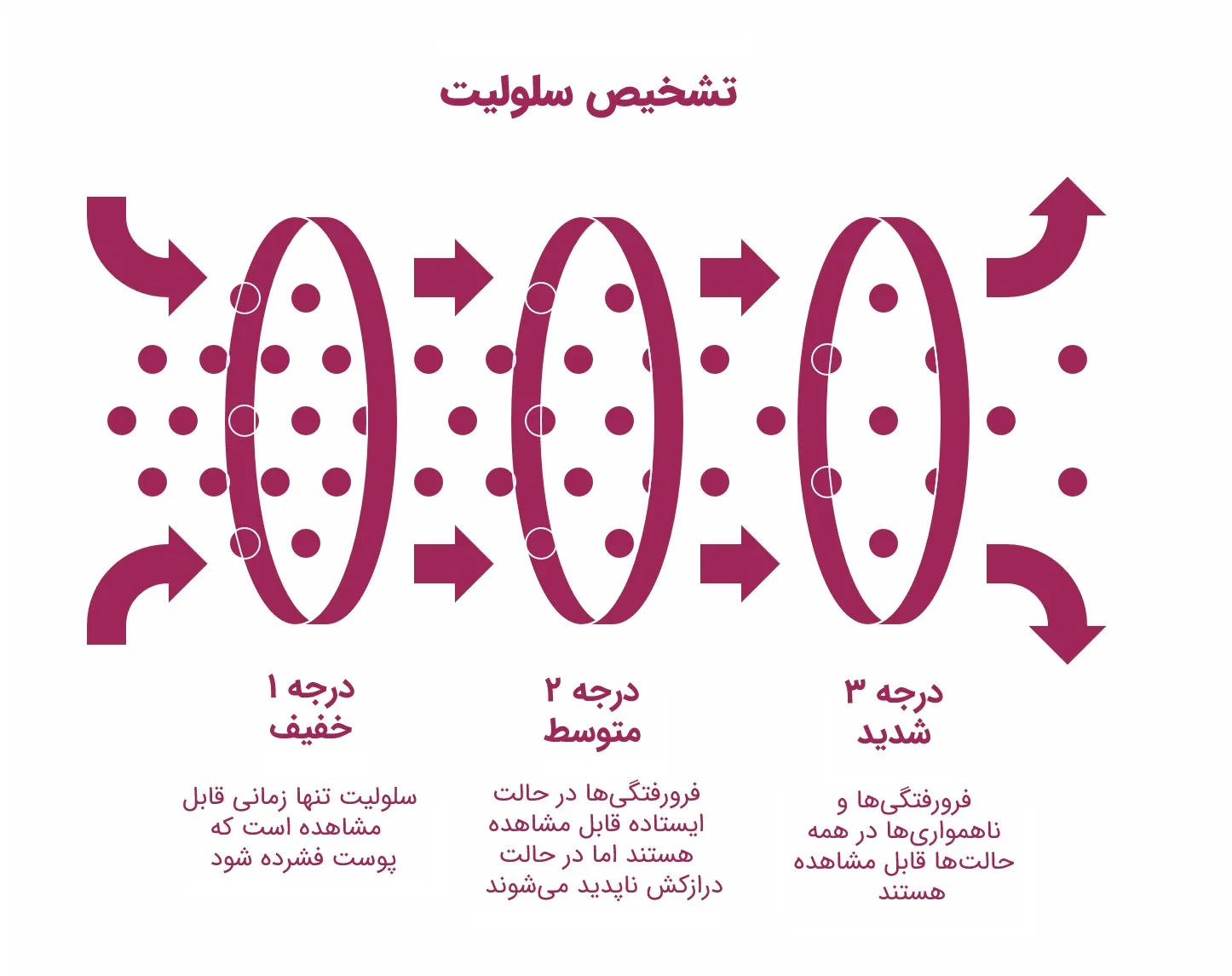 اینفوگرافیک درجهبندی شدت سلولیت