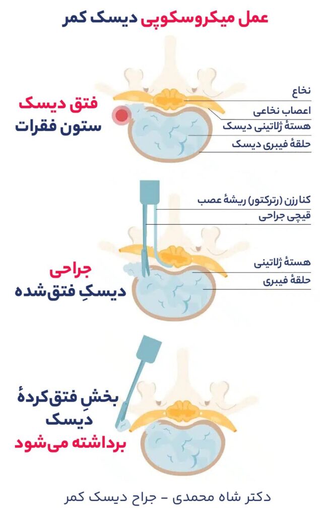 روش جراحی دیسک کمر با عمل میکرو دیسککتومی - عمل میکروسکوپی دیسک کمر - دکتر محمدرضا شاه محمدی