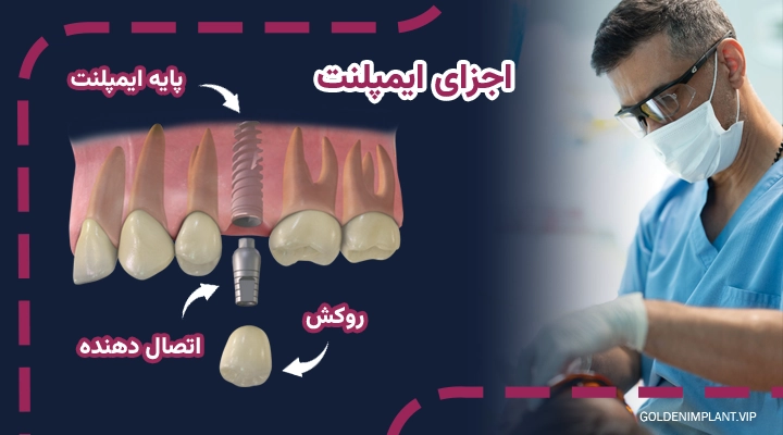 اجزای ایمپلنت دندان