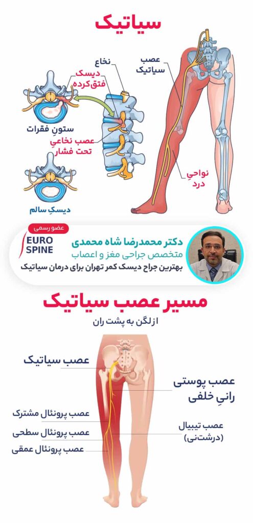 سیاتیک چیست؟ - مسیر عصب سیاتیک