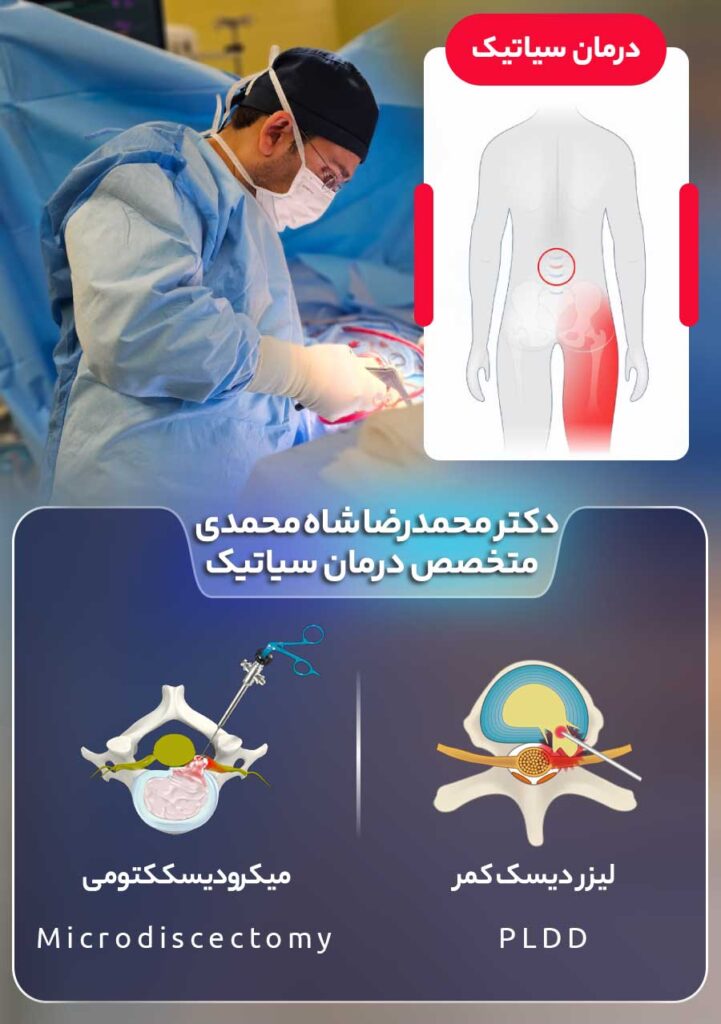 جراحی دیسک کمر در درمان قطعی سیاتیک؛ پیشنهاد دکتر محمدرضا شاه محمدی