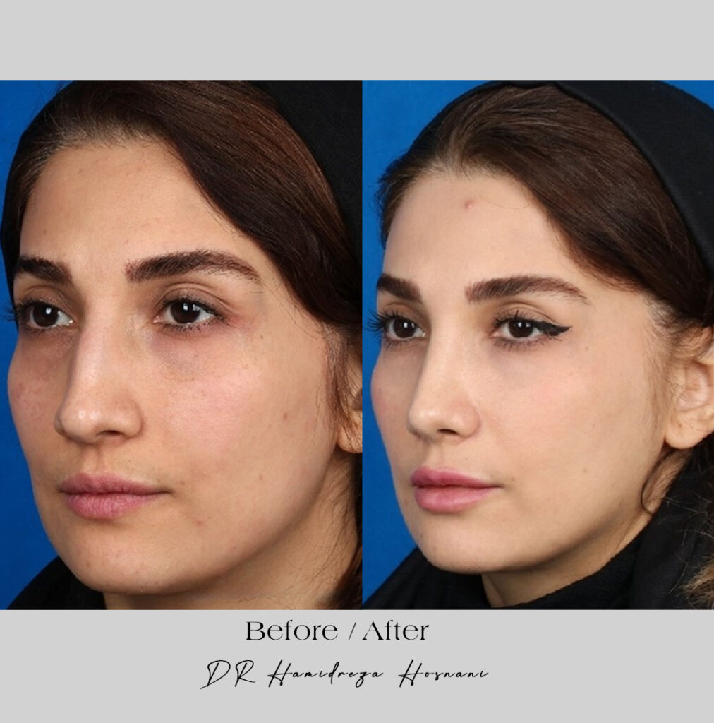 bony-nose-before-after