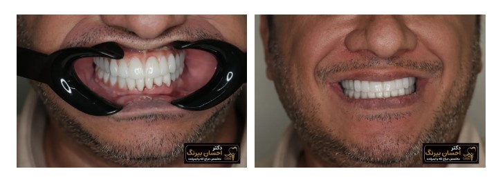 نمونه درمان ایمپلنت فوری در تهران توسط دکتر احسان بیرنگ
