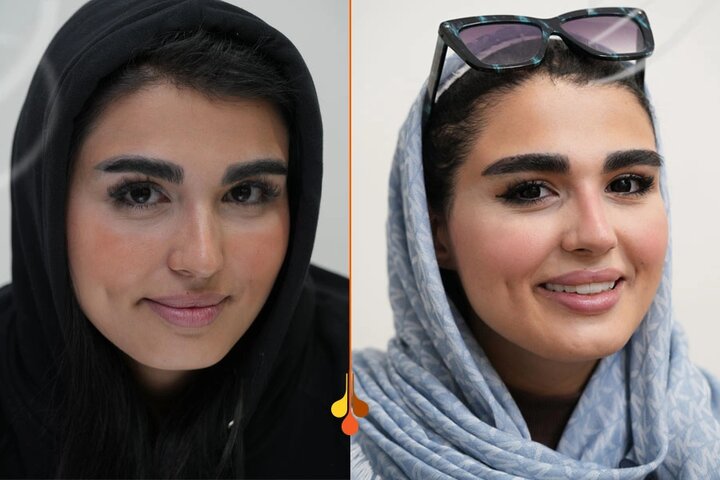 کاشت ابرو به روش NTF